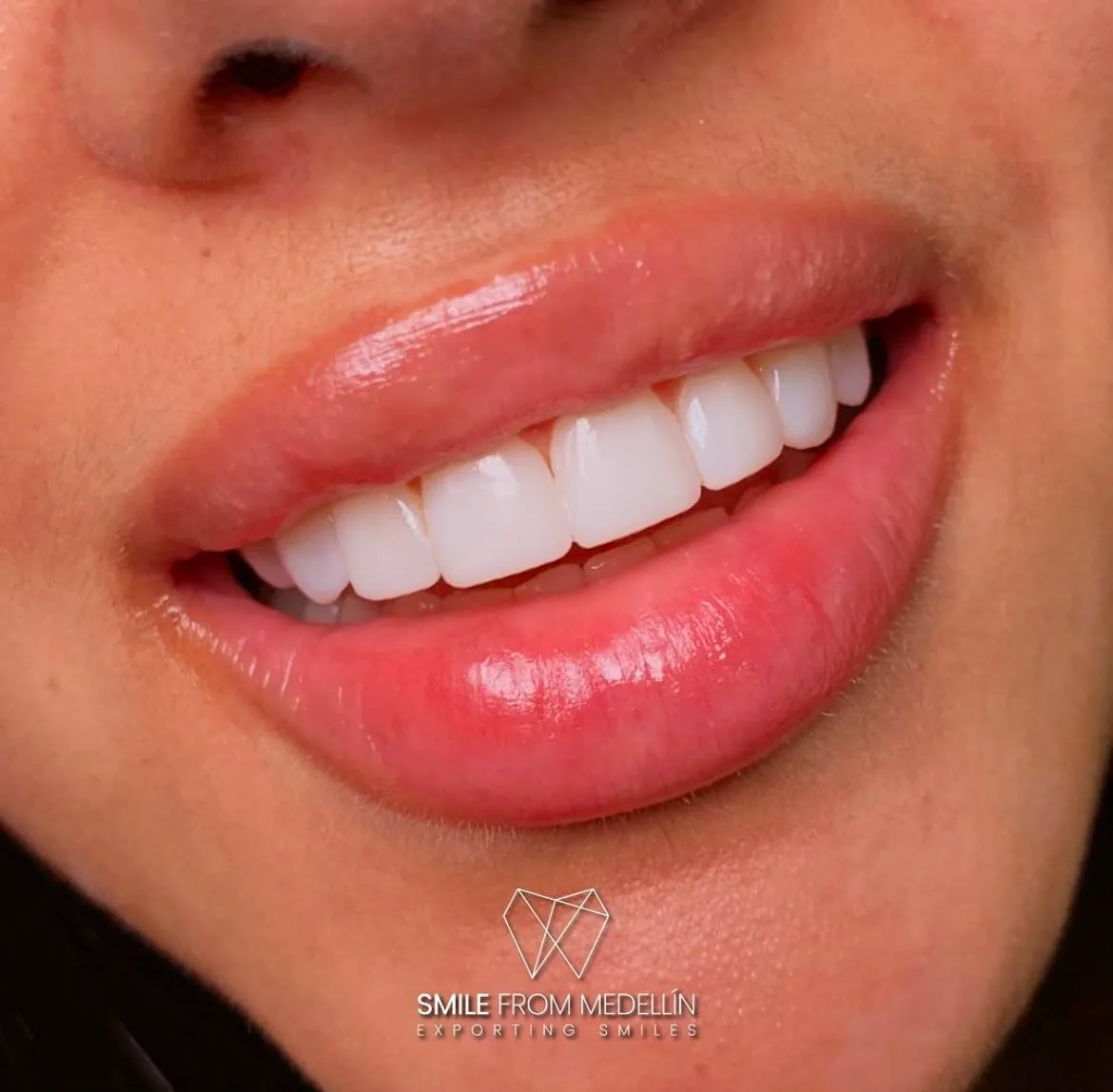 Completed porcelain veneer smile makeover at a Medellín dental clinic
