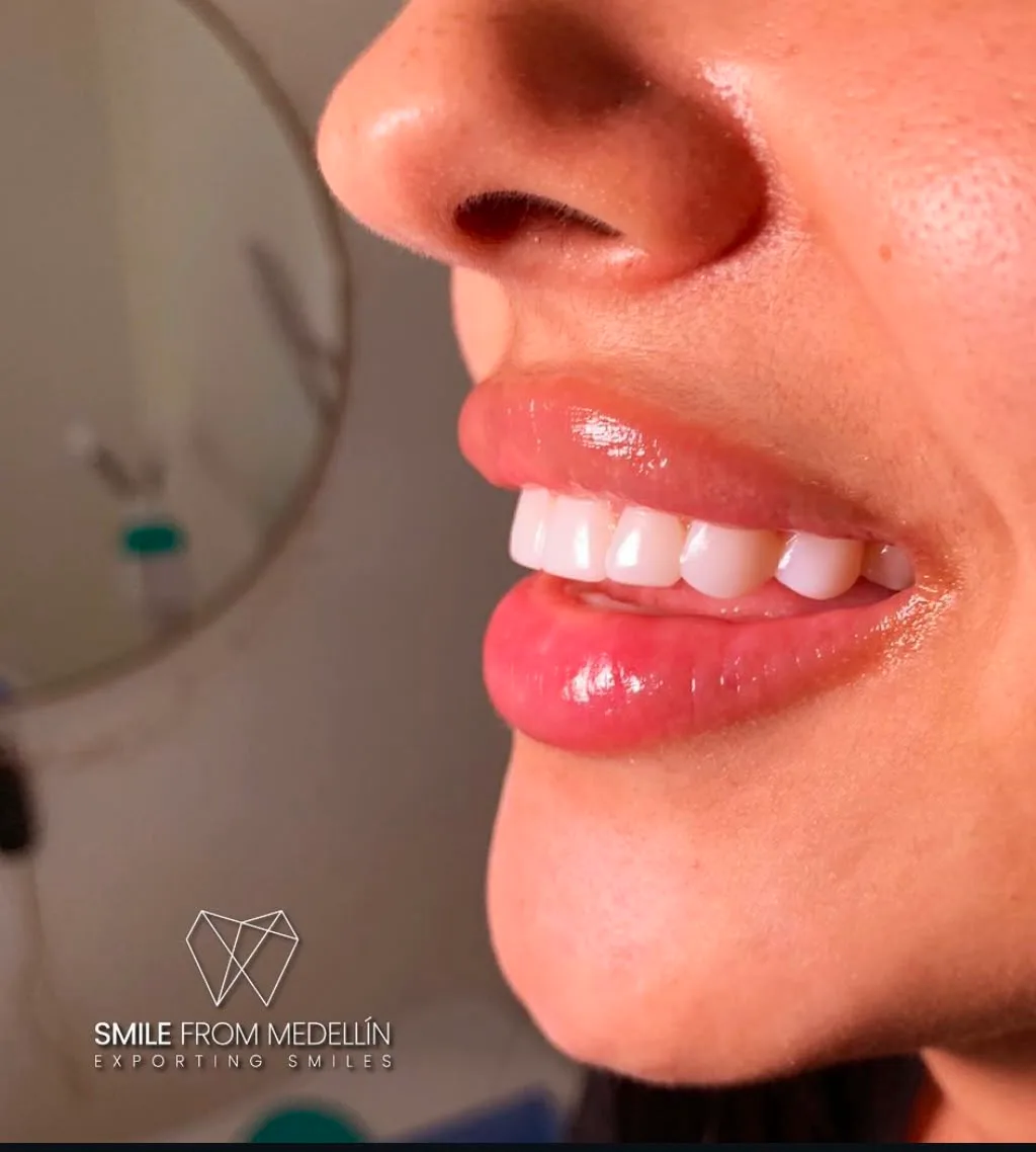 Porcelain veneers in Medellín, side view of the smile design