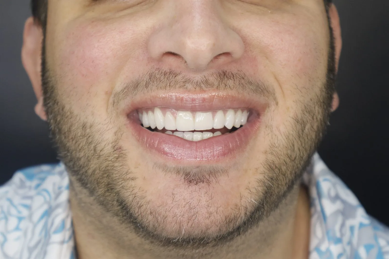 Resultado real después del diseño de sonrisa en Smile From Medellín