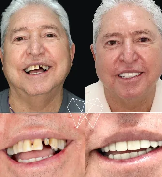 Implantología en Smile From Medellín