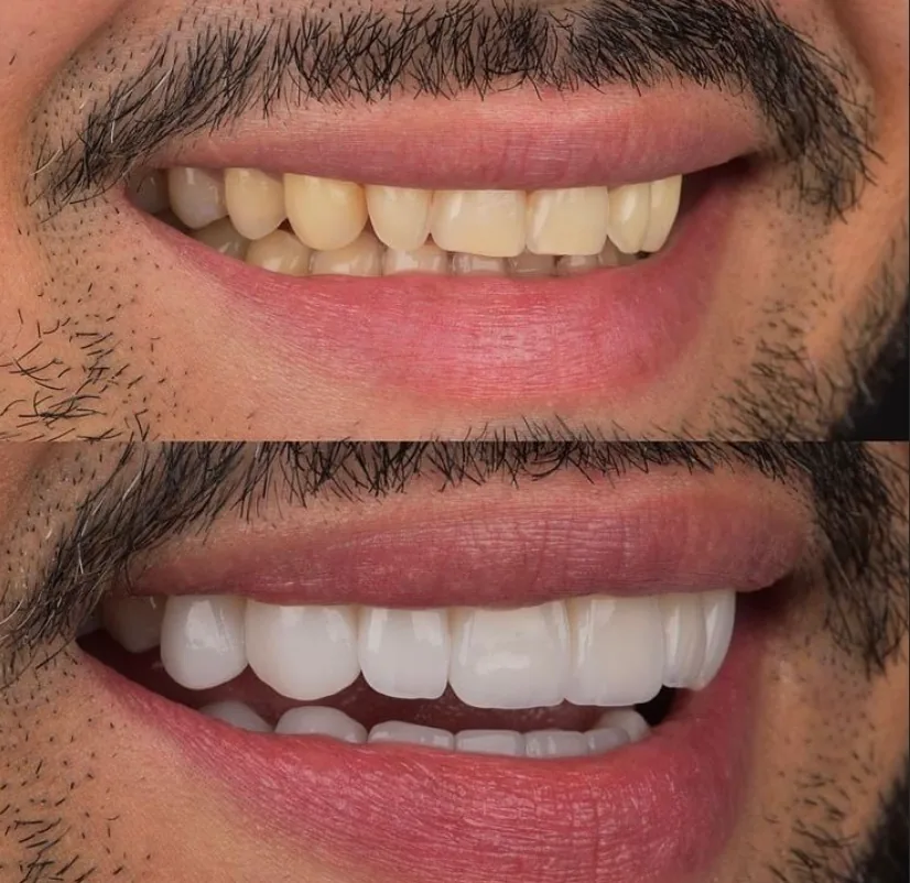 Veneers and teeth whitening result in Medellín