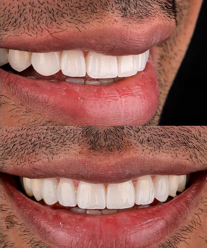 Before and after veneer smile makeover at Smile From Medellín