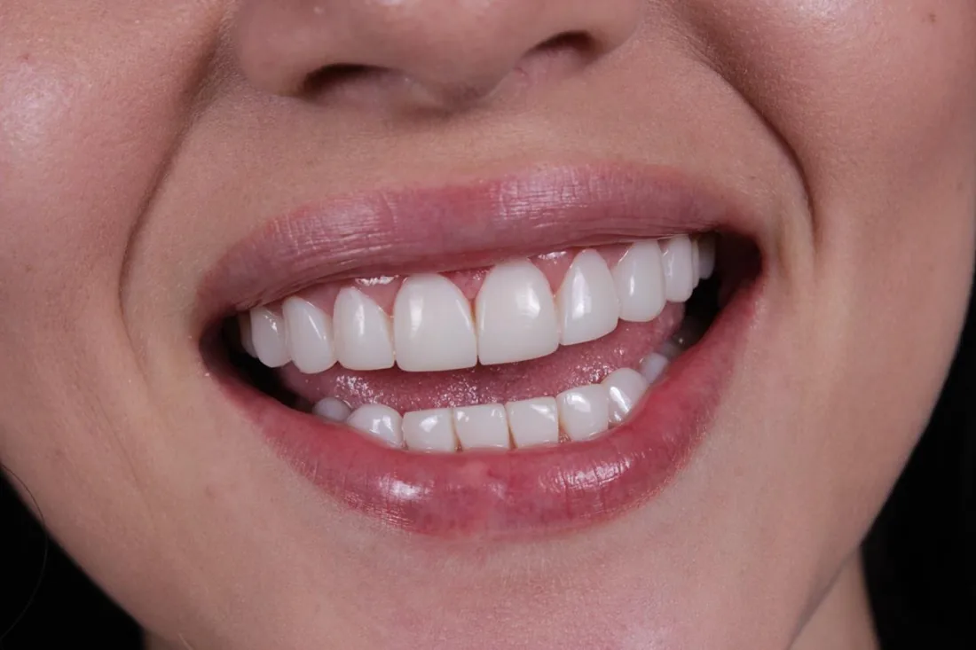 Resultado real de carillas en Smile From Medellín