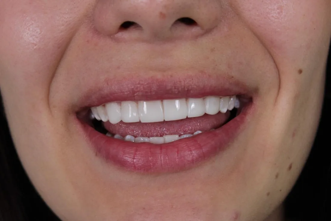 Resultado de carillas dentales en un paciente real