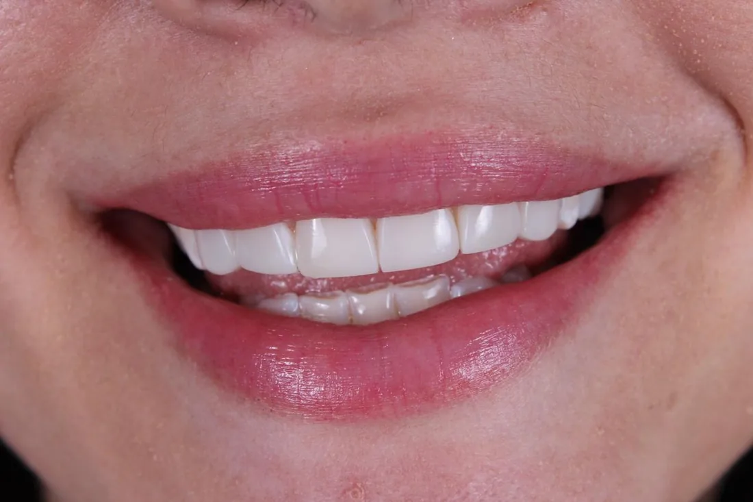 Resultado de diseño de sonrisa