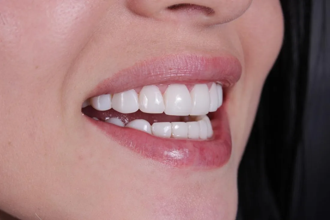 Resultado real de diseño de sonrisa de Smile From Medellín
