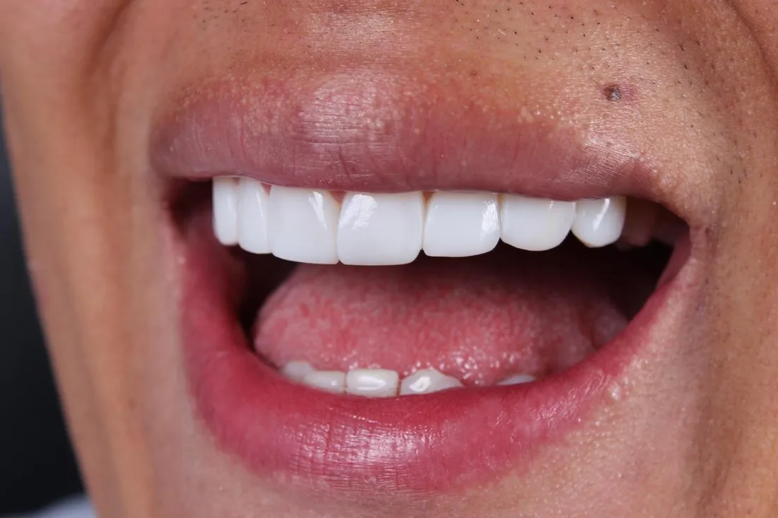 Diseño de sonrisa terminado