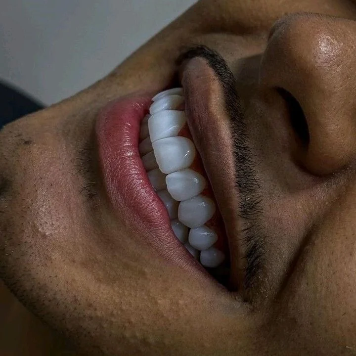 Sonrisa con carillas de porcelana de Smile From Medellín